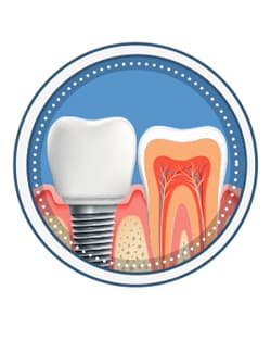 Dental implants