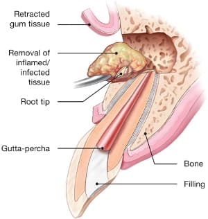Endodontic microsurgery procedure