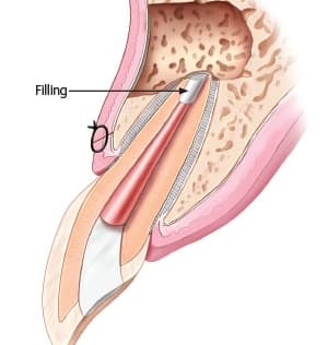 Endodontic microsurgery close-up