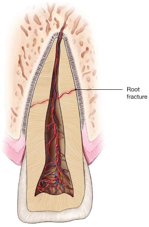 Tooth root fracture