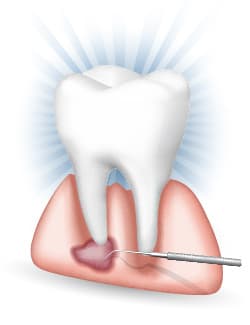 Illustration of endodontic microsurgery