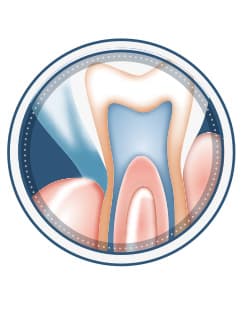Illustration of endodontic retreatment