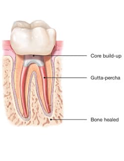 Diagram of root canal procedure