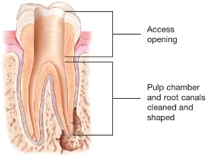 Root canal illustration